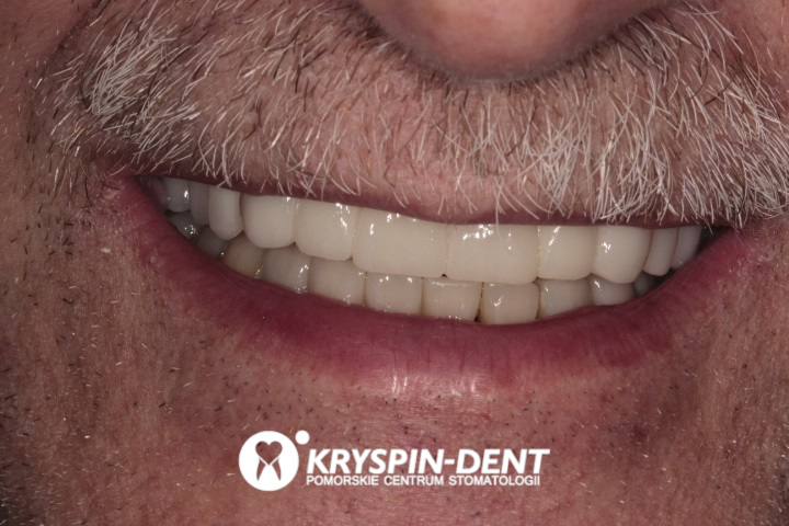 uzębienie pacjenta po metamorfozie