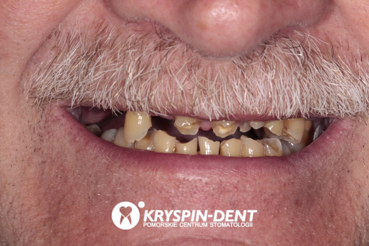 zdjecie zębów pacjenta przed metamorfozą